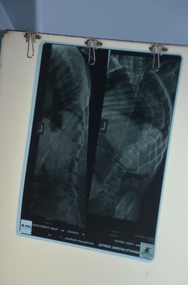 X-Ray from a medical trip to provide spinal surgeries in Kenya. (Photo courtesy Dr. Rod Oskouian)