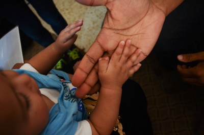 A volunteer doctor shows a birth defect on a refugee child's thumb, thought to be caused by exposure to chemicals agents in explosives used in the civil war. (Photo by Alisa Reznick)