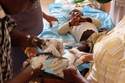 Mohamed being treated for clubfoot using the Ponseti Method, a non-surgical technique using a series of casts and braces. (Photo by Debra Bell)